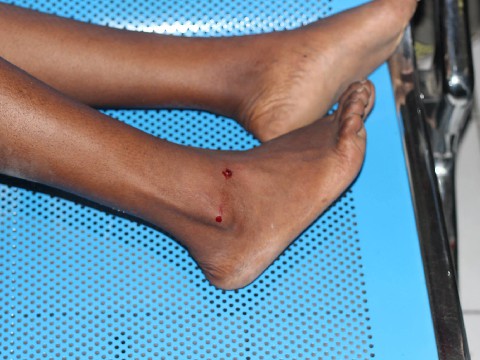 Rubber bullets mark protester's legs